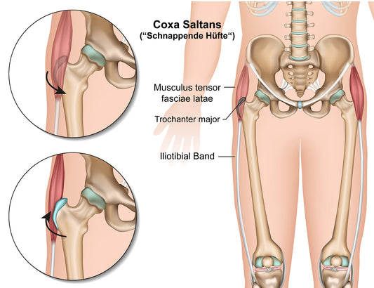 Guide to Snapping Hip Syndrome Treatment
