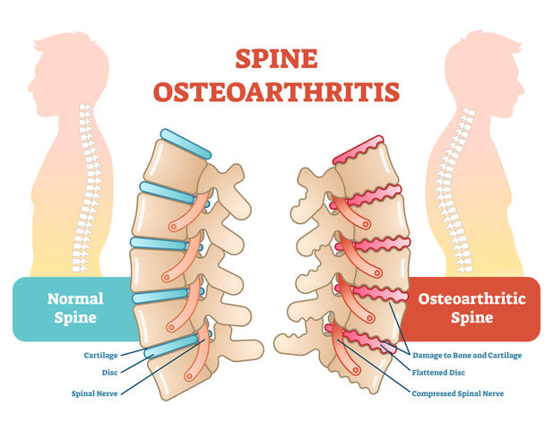 Spinal Arthritis Treatments for Pain Management