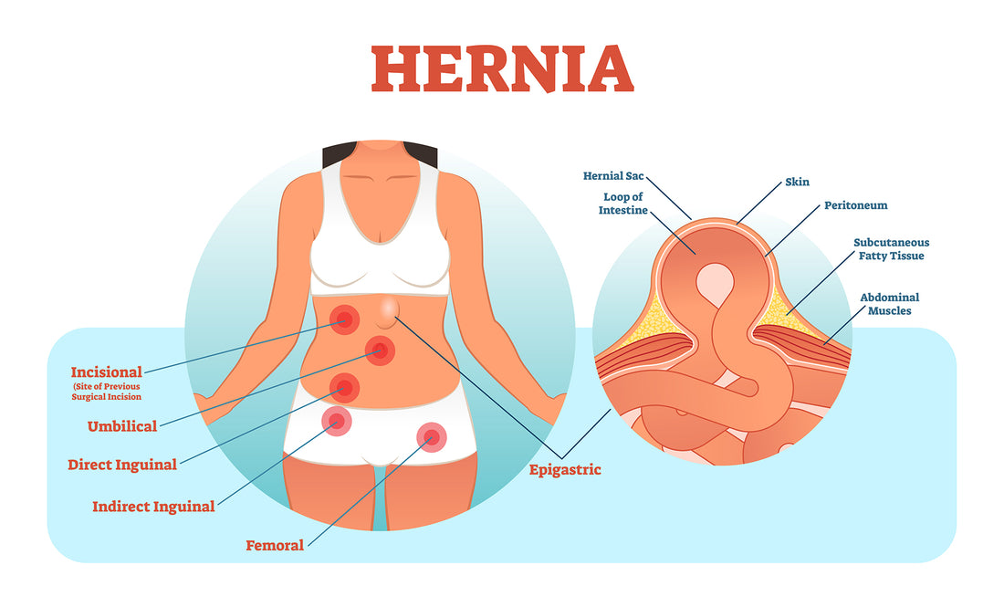 7 Tips for Smooth Hernia Surgery & Recovery