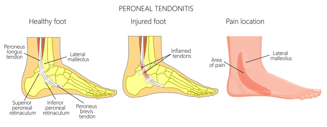 Peroneal Tendonitis & Tear Overview