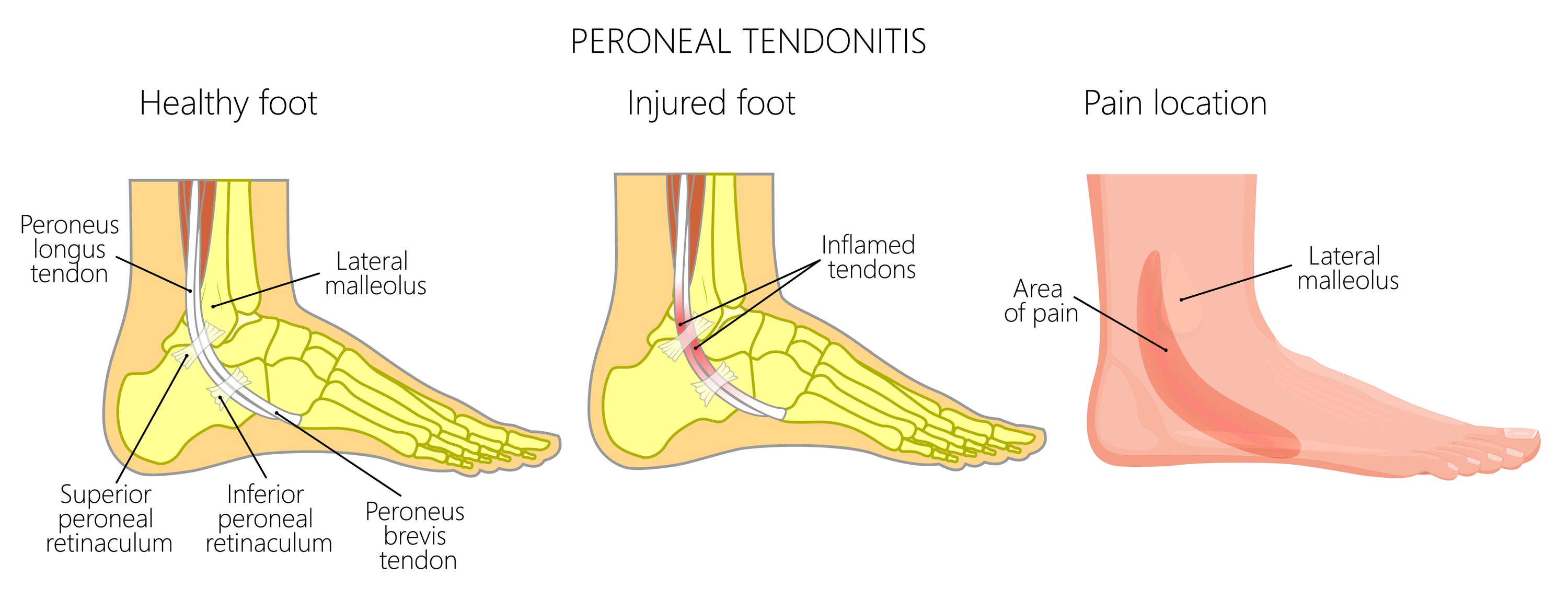 Peroneal Tendonitis & Tear Overview Sacksy Thyme