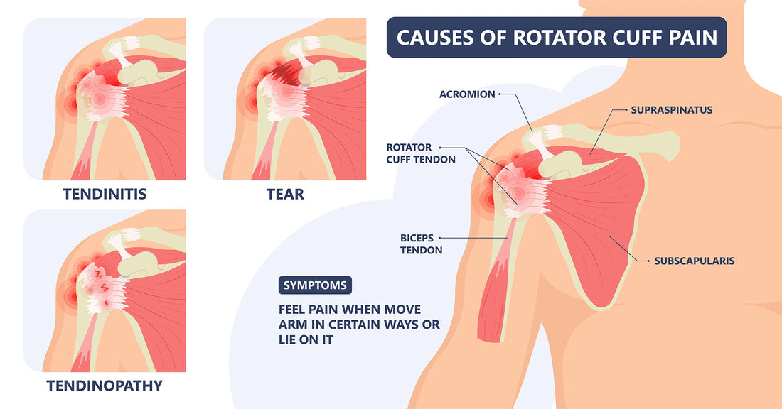 Rotator Cuff Tear Overview