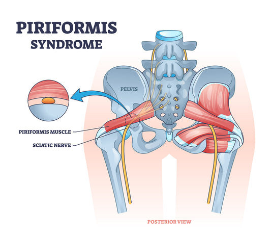 Piriformis Syndrome - Understanding the Pain