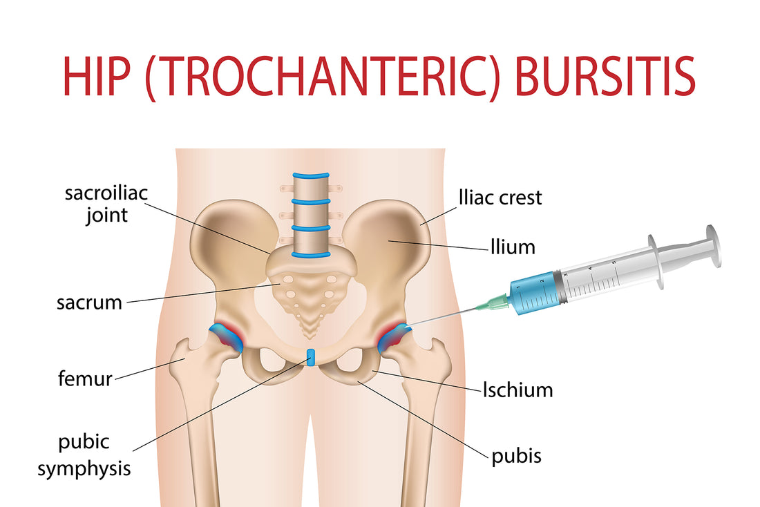 How to Treat Hip Bursitis Pain – Sacksy Thyme