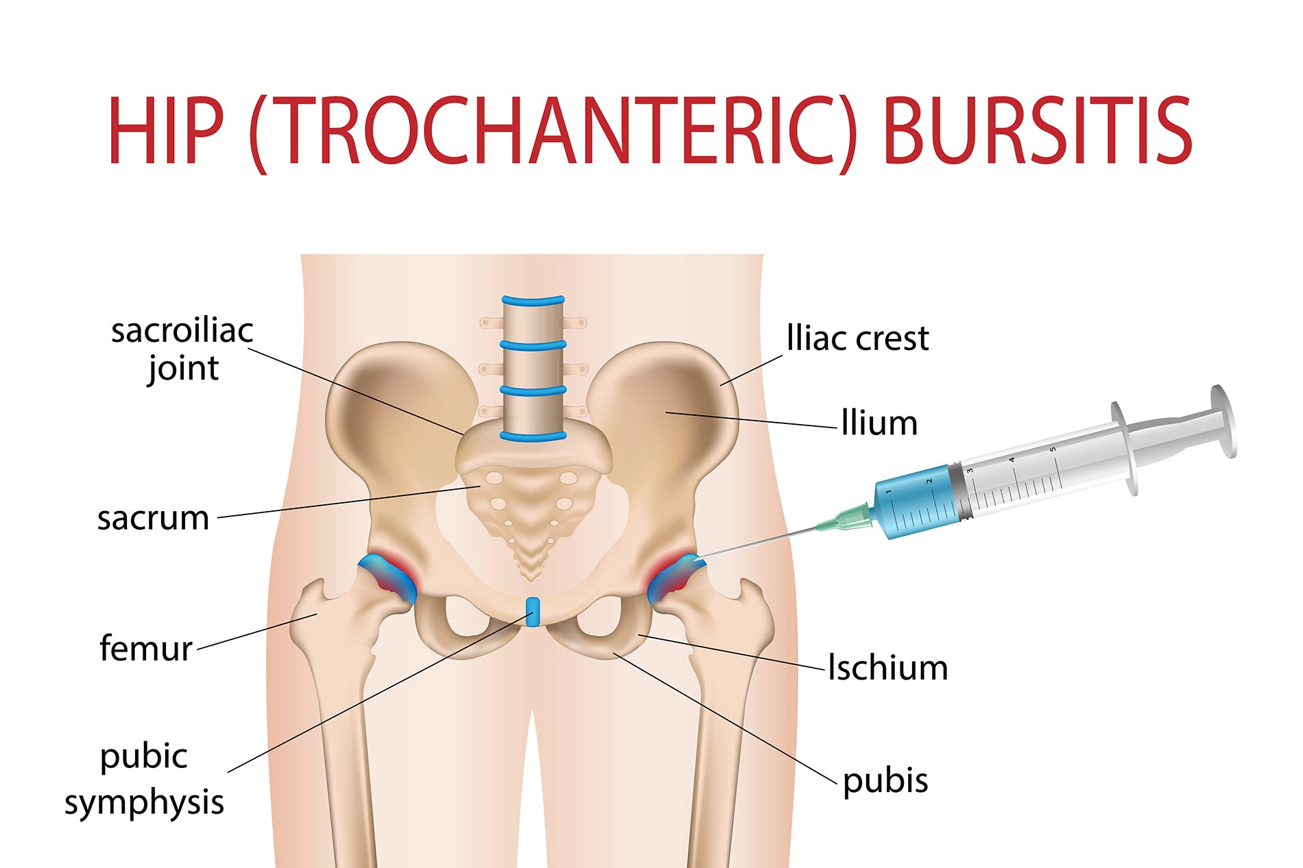 How to Treat Hip Bursitis Pain