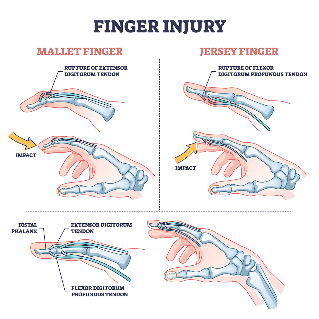 Mallet Finger Overview