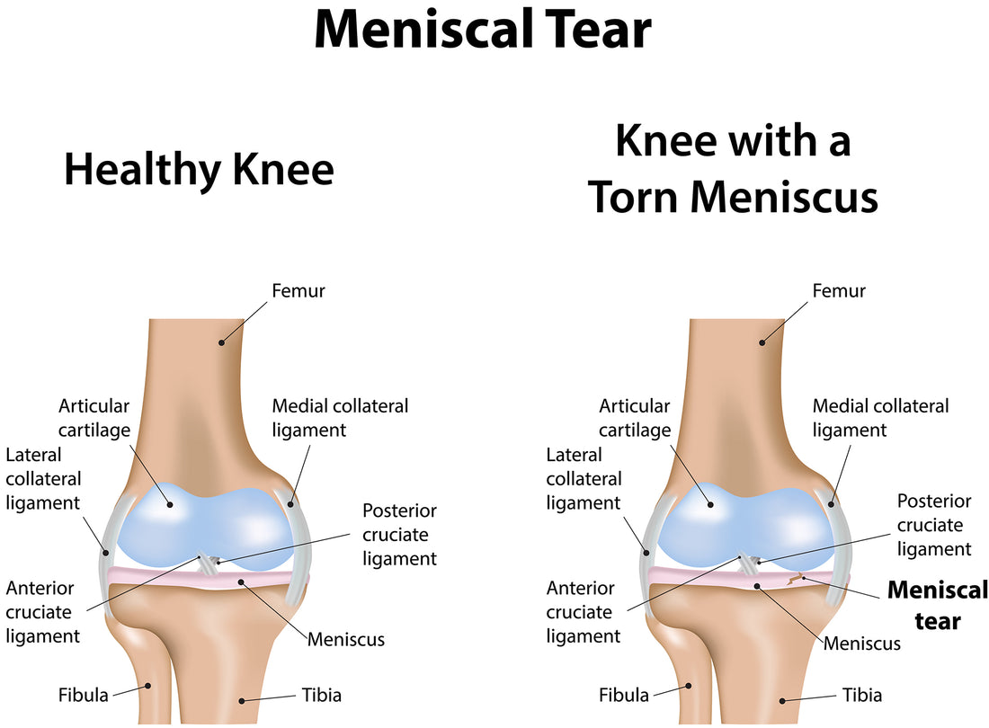 Meniscus Tear Overview